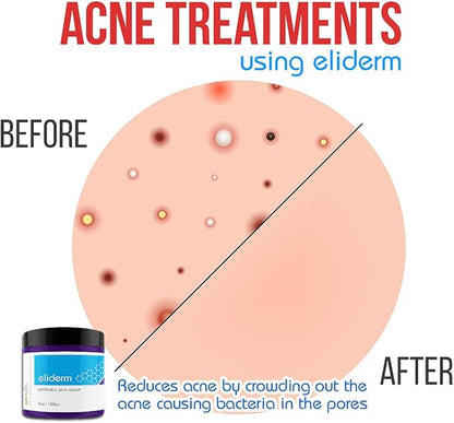 Topical Probiotic Skin Cream - 4OZ Jar 13 Strain Moisturizing Probiotic Lotion Eczema Treatment Psoriasis Treatment for Cystic Acne Probiotic Skin Care Cream Nail Fungus Treatment
