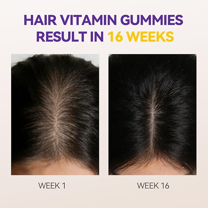 Hair Growth Multivitamins Gummies Sugar Free Biotin Gummies 10000mcg with Collagen, Keratin, Silicon, MSM & Omega-3 Vegan Hair Growth Supplement for Women - 120 Gummies - 60 Servings
