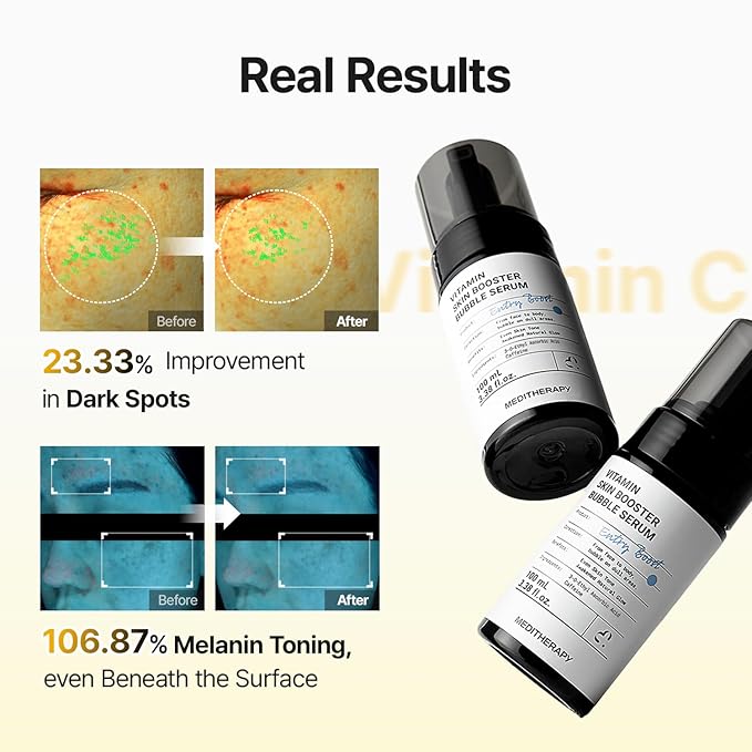 MEDITHERAPY Vitamin C Serum for Face – Micro-Bubble Formula for Instant Absorption, Visibly Radiant Glow – Advanced Vitamin C, Non-Irritating AM/PM Use for Sensitive Skin – 3.38 fl oz