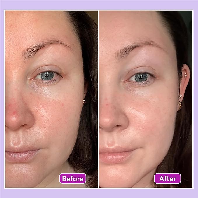 Q+A Azelaic Acid Balancing Serum (30ml), Natural Face Serum with Zinc PCA and Antioxidant Super Grains, Fragrance Free Skincare, Smoothes Skin