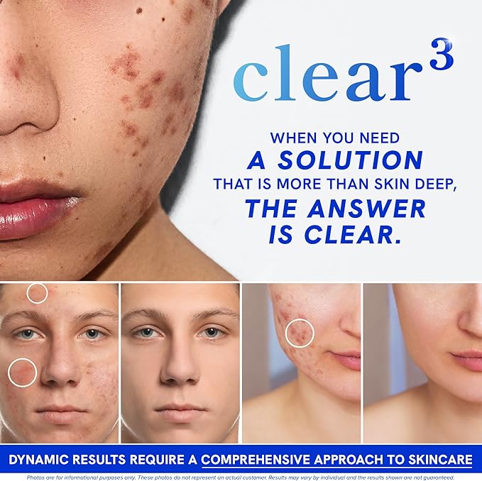 Clear Skin Supplement with Zinc, DIM & Probiotics | 3-in-1 Balance, Glow & Health Skin Support | Triple Action Hyaluronic Acid, Niaciminide & Vitamins for Hormone, Complexion & Gut Support | 180 Ct