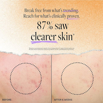 Derma E Acne Deep Pore Cleansing Wash – Blemish Control Facial Cleanser with Salicylic Acid - Gentle Oil Control Face Wash Soothes and Balances Skin, 6 fl oz